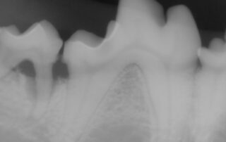 DENT2